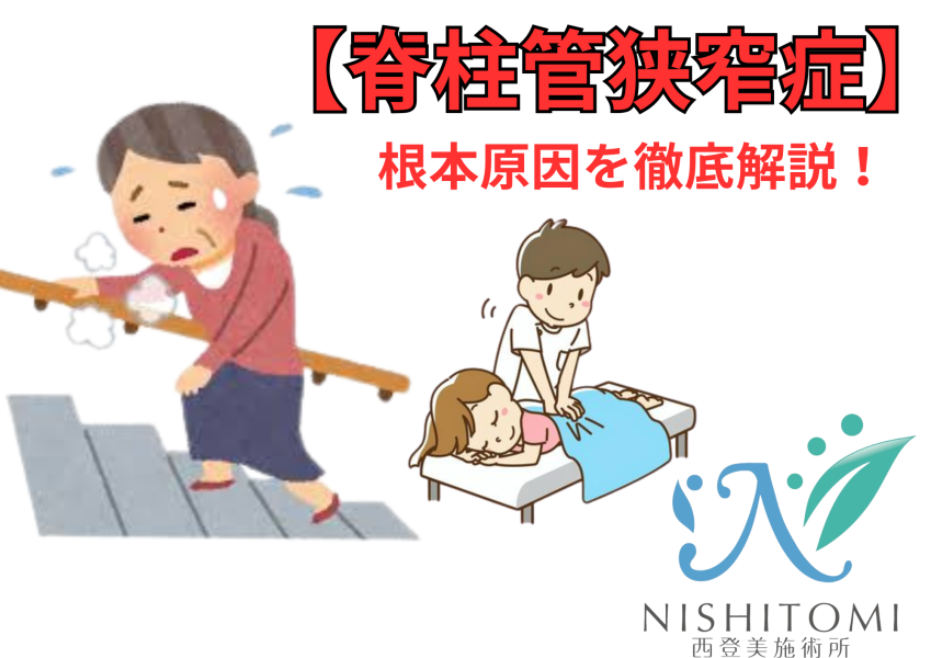 脊柱管狭窄症　原因