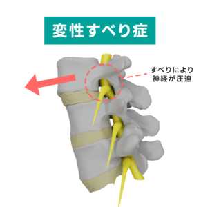 変性すべり症-2